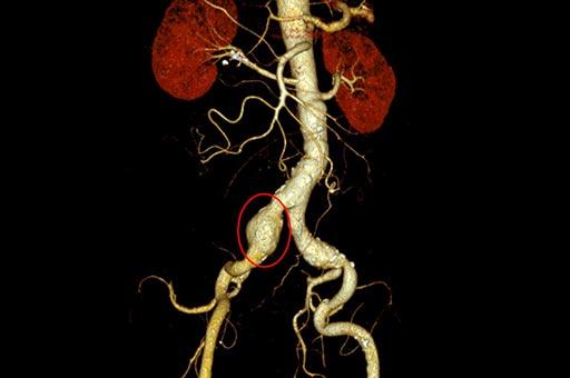 iliac aortic aneurysm