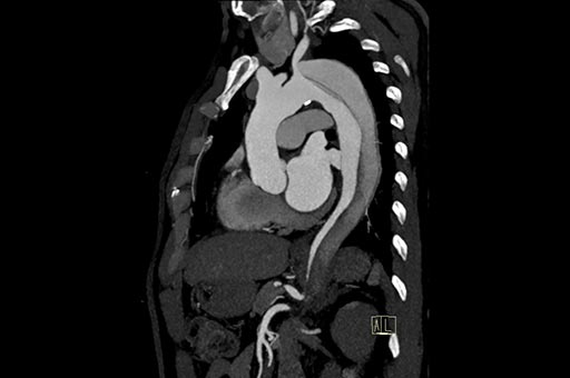 aortic dissection