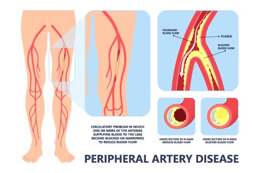 vascular surgery for arterial disease