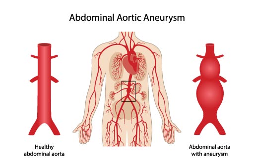 abdominal aortic aneurysm