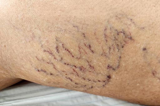 spider veins treatment