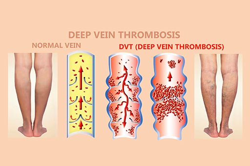 deep vein thrombosis treatment