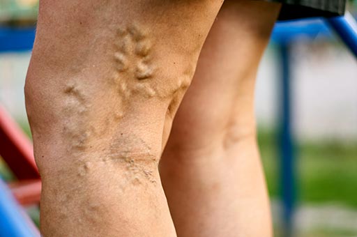 varicose veins treatment