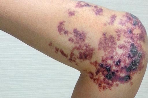 venous malformation treatment