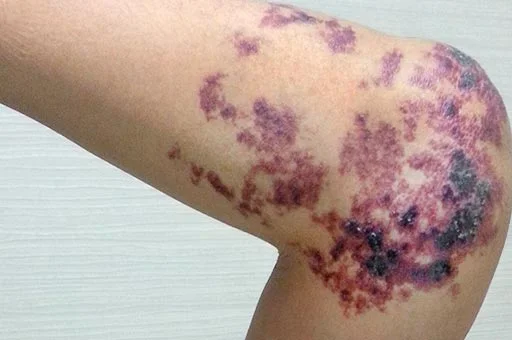 venous malformation treatment