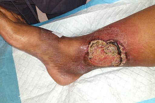 venous ulcer treatment