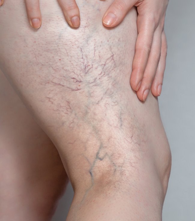 Recognising the First Signs of Varicose Veins