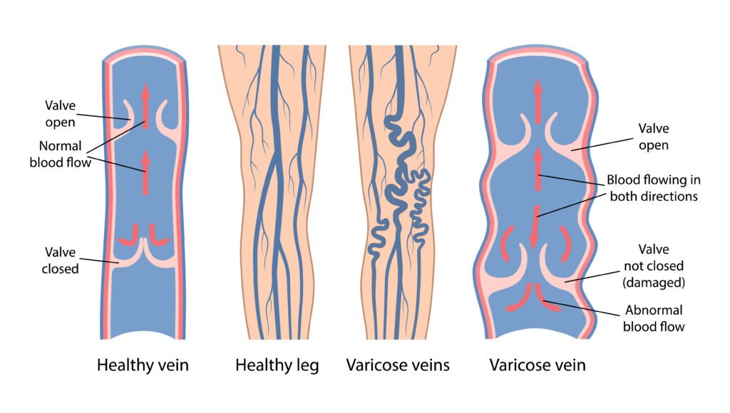 Illustration comparing healthy and varicose veins.