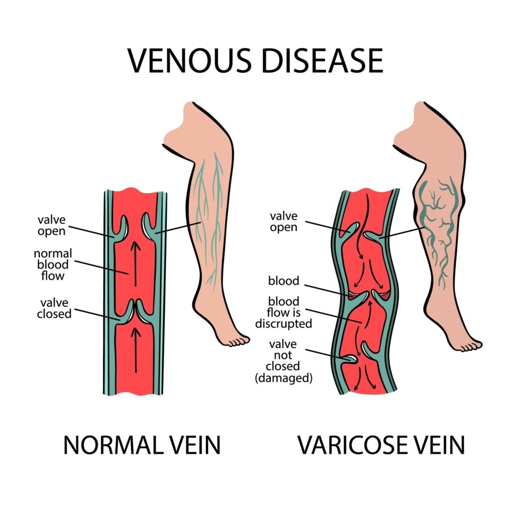 An illustration of blood flow in varicose veins