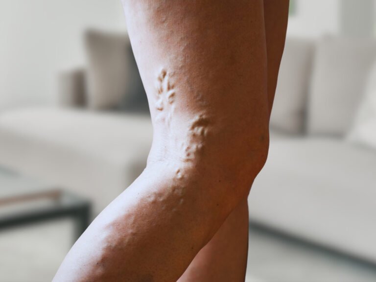 Close-up of leg veins showing visible vein changes