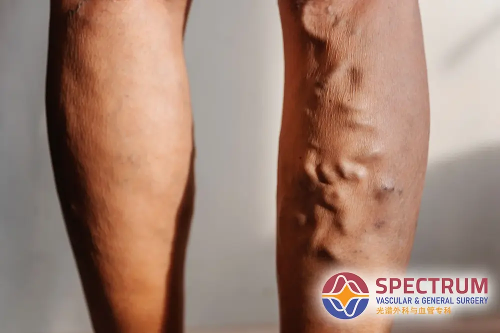 Leg with visible varicose veins – Spectrum Vascular and General Surgery Singapore