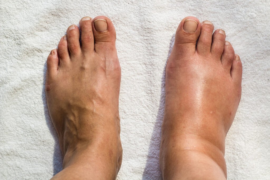Side-by-side image showing leg and foot swelling compared with a normal foot