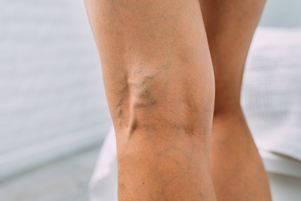 Close-up view of varicose veins affecting the leg