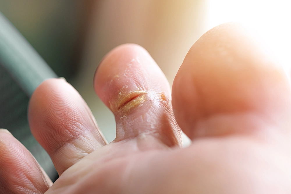 Inspect Your Feet Daily