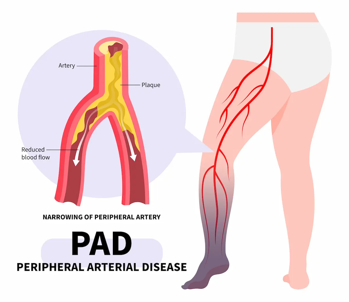 illustration of narrowing of peripheral artery