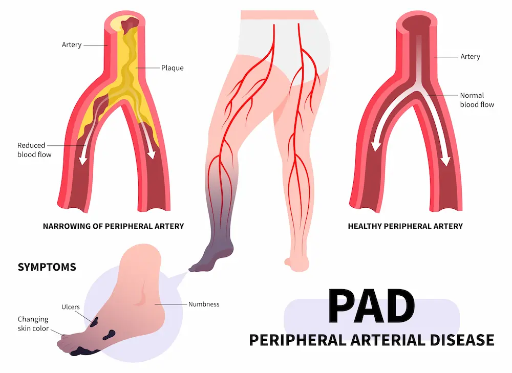 illustration of symptoms in the feet due to Peripheral Artery Disease