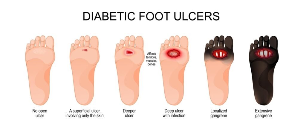 Diabetic foot ulcer stages - from no open ulcer to superficial ulcer, deeper ulcer, deep ulcer with infection, localised gangrene and extensive gangrene