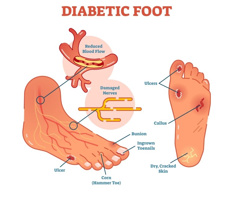 Medical diagram of a diabetic foot showing reduced blood flow, damaged nerves, ulcer, callus, bunion, ingrown toenails, corn and dry cracked skin