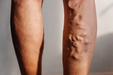 An image comparing healthy and varicose veins